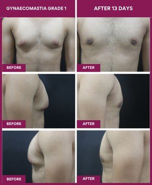 Gynecomastia Surgery Cost 4 13 days post gynecomastia grade 1 surgery result: 27 y male/ Gym trainer/ was not able to get read of male breast even after chest muscle build up carrier