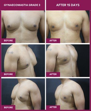 Gynecomastia Surgery Cost 2 15 days post gynecomastia grade 3 surgery result: 29 y male/ Finance professional/ was feeling shy in meetings
