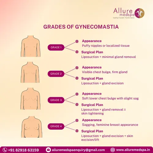 Grades of Gynecomastia in Mumbai, India