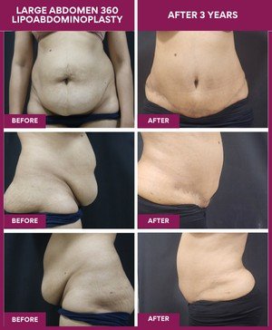 Tighten Your Abs with a Mini Tummy Tuck for Active, Fit Moms 1 3 years post 360 tummy tuck surgery result: 40y /80 kg / female/ post delivery/ suffering from hanging aprone, having problem in dressing and personal hygiene amd marriage life