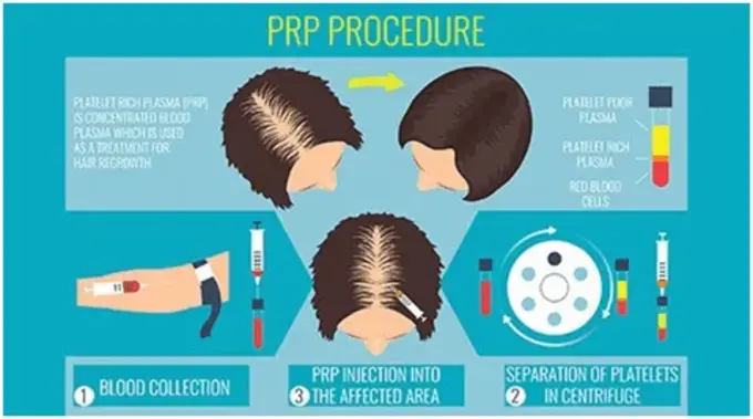 PRP Treatment Procedure in Mumbai, India