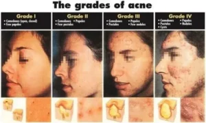 Acne Treatment 10 The Grades of Acne in Mumbai, India