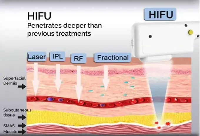 What Happens Inside the Skin During HIFU Treatment in Mumbai, India