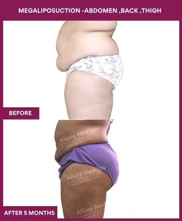 Liposuction Surgery 2 1- MEGALIPOSUCTION -ABDOMEN ,BACK ,THIGH-1