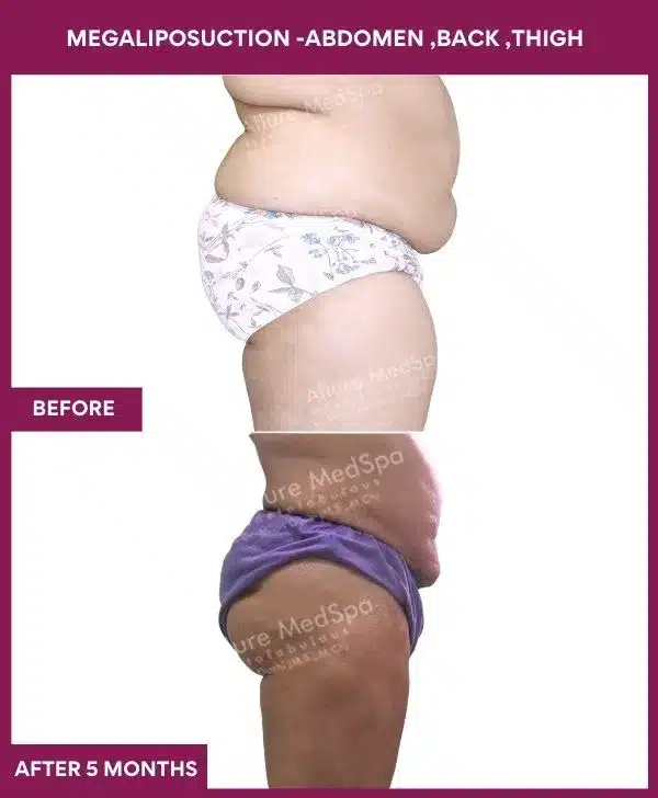 Liposuction Surgery 4 1- MEGALIPOSUCTION -ABDOMEN ,BACK ,THIGH