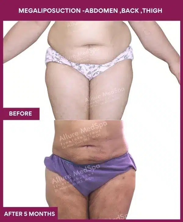 Liposuction Surgery 3 1-MEGALIPOSUCTION -ABDOMEN ,BACK ,THIGH