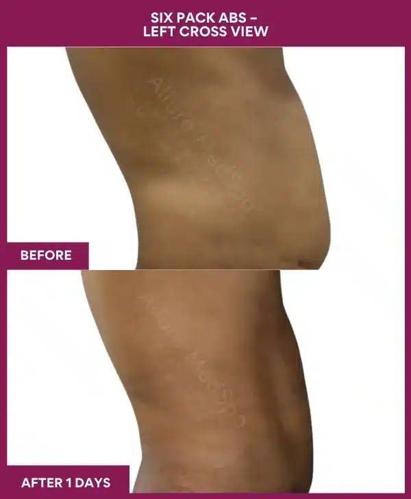 Liposuction Surgery 17 11-10-9-Six Pack Abs--