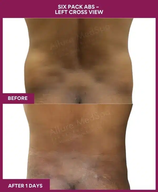 Liposuction Surgery 19 11-10-9-Six Pack Abs-