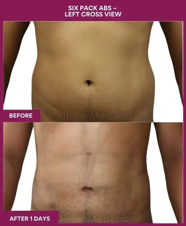 Liposuction Surgery 18 11-10-9-Six Pack Abs