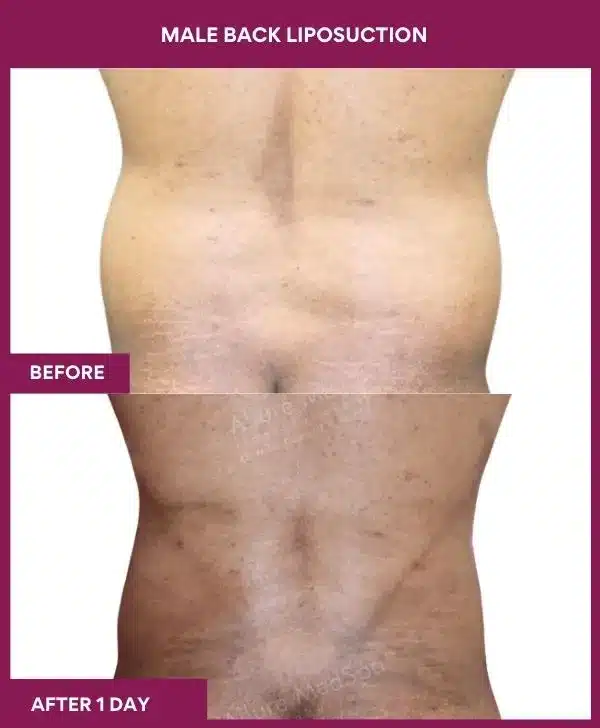 Liposuction Surgery 37 12-Male Back liposuction