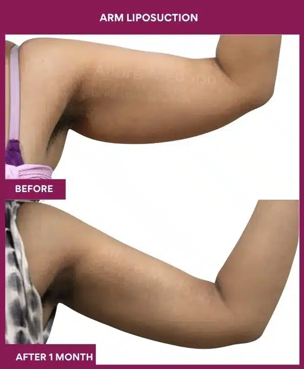 Liposuction Surgery 29 14-arm LIPOSUCTION
