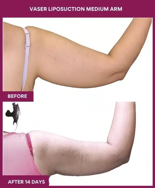 Liposuction Surgery 35 16 VASER LIPOSUCTION MEDIUM ARM-