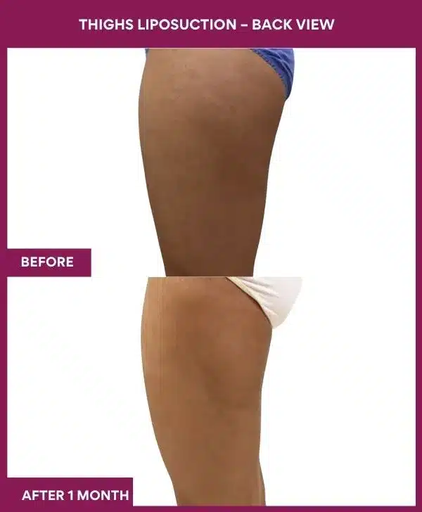 Liposuction Surgery 26 18 Thighs Liposuction – Back View--