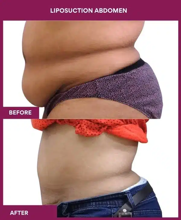Liposuction Surgery 5 2- liposuction abdomen--