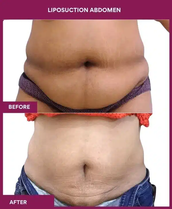 Liposuction Surgery 6 2- liposuction abdomen
