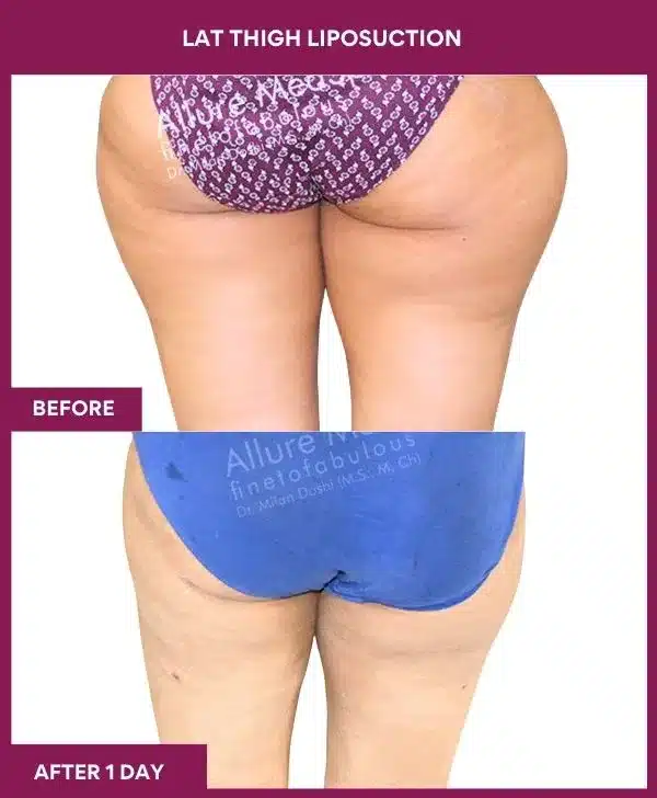 Liposuction Surgery 20 20 LAT THIGH LIPOSUCTION--