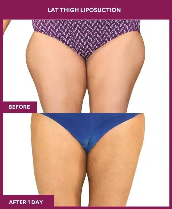 Liposuction Surgery 21 20 LAT THIGH LIPOSUCTION