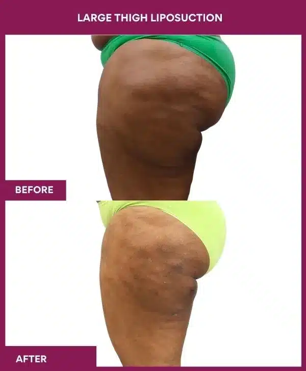 Liposuction Surgery 25 22 Large Thigh Liposuction-