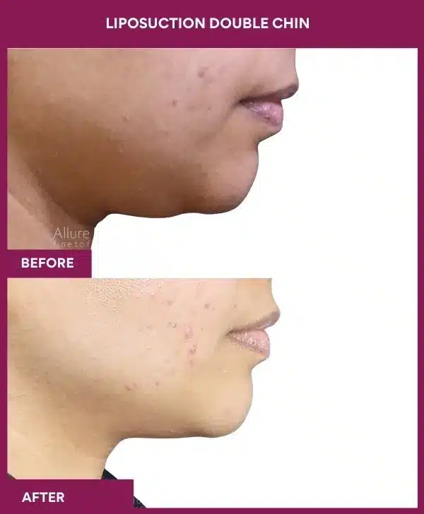 Liposuction Surgery 34 23 LIPOSUCTION DOUBLE CHIN