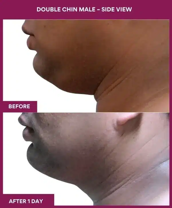 Liposuction Surgery 31 24 Double Chin Male – Side View