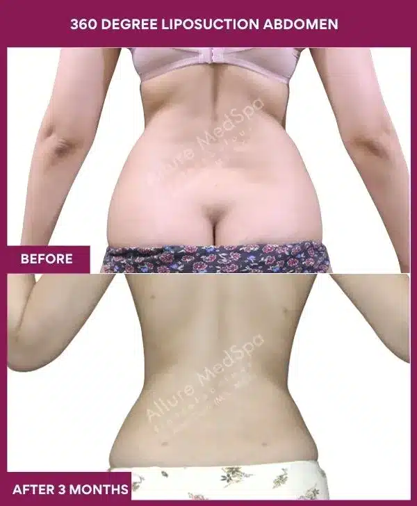 Liposuction Surgery 8 4- 360 DEGREE LIPOSUCTION ABDOMEN--