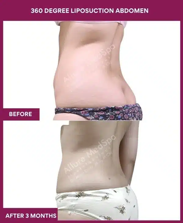 Liposuction Surgery 10 4- 360 DEGREE LIPOSUCTION ABDOMEN-