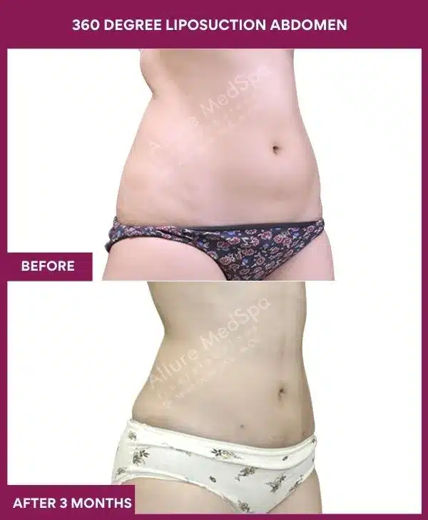 Liposuction Surgery 9 4- 360 DEGREE LIPOSUCTION ABDOMEN