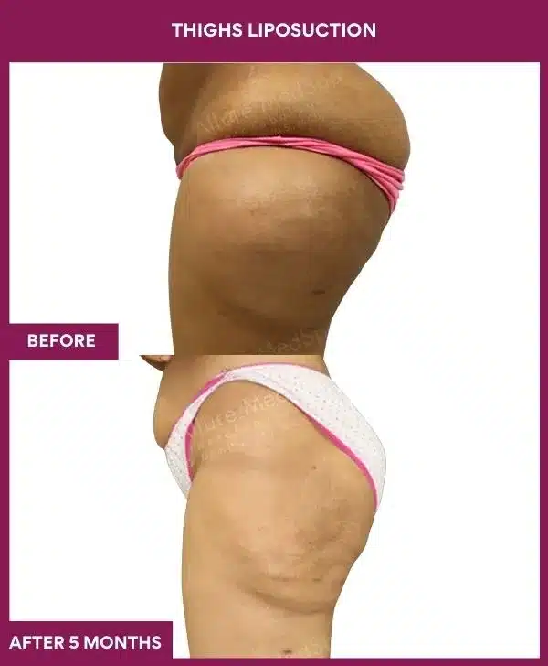 4 Thighs Liposuction_83 (4)