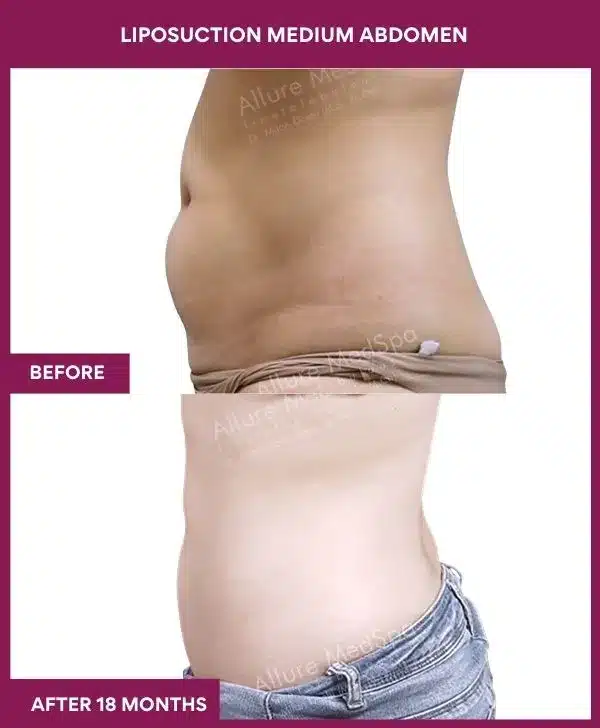 Liposuction Surgery 11 6- liposuction medium abdomen--