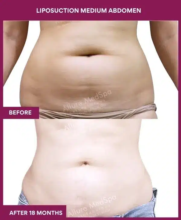 Liposuction Surgery 12 6- liposuction medium abdomen