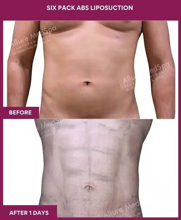 Liposuction Surgery 15 8- Six Pack Abs Liposuction