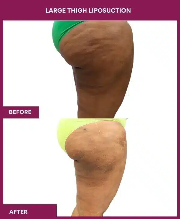 9 Large Thigh Liposuction-- (1)