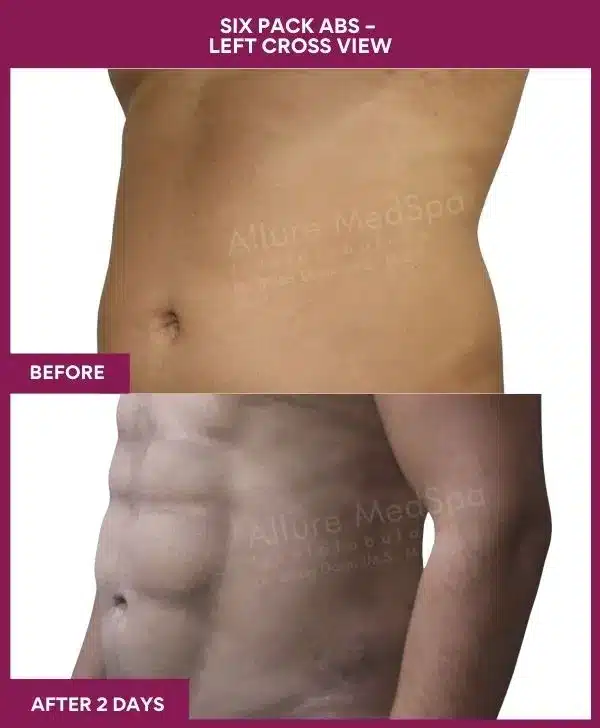 Liposuction Surgery 40 9-Six Pack Abs
