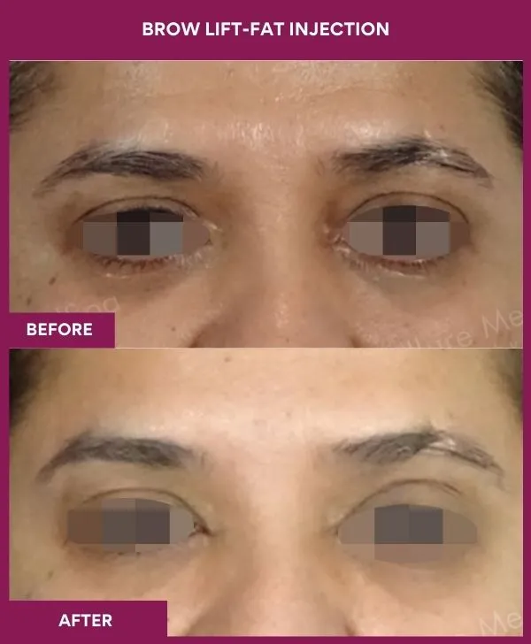 Brow Lift Surgery 4 1 BROW LIFT-ENDOSCOPIC (2)_1