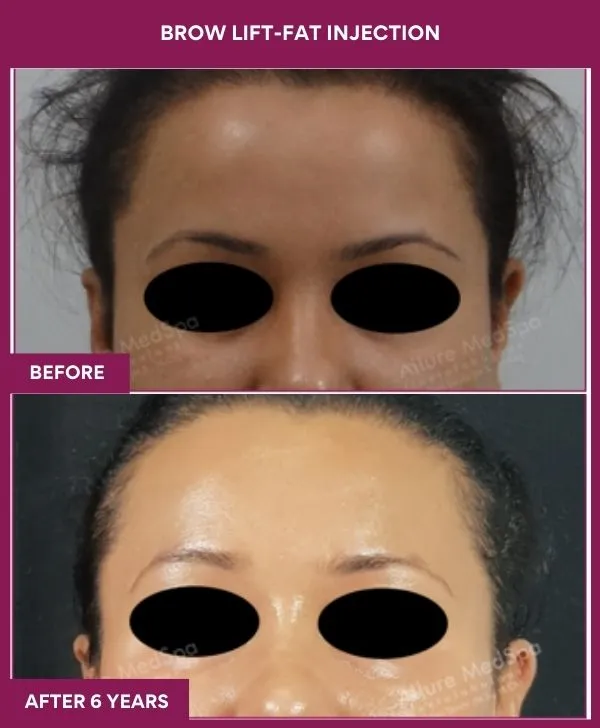 Brow Lift Surgery 2 4 BROW LIFT-ENDOSCOPIC_12_