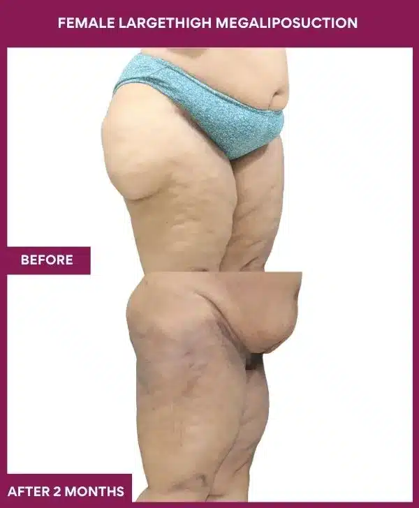 Liposuction Before After Gallery 134 FEMALE LARGE THIGH MEGA LIPOSUCTION in Mumbai, India