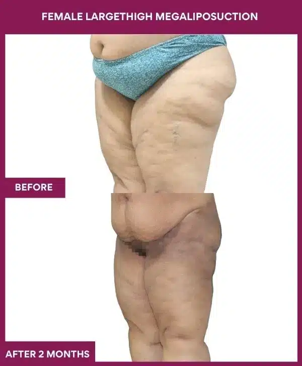 Liposuction Before After Gallery 132 FEMALE LARGE THIGH MEGA LIPOSUCTION in Mumbai, India