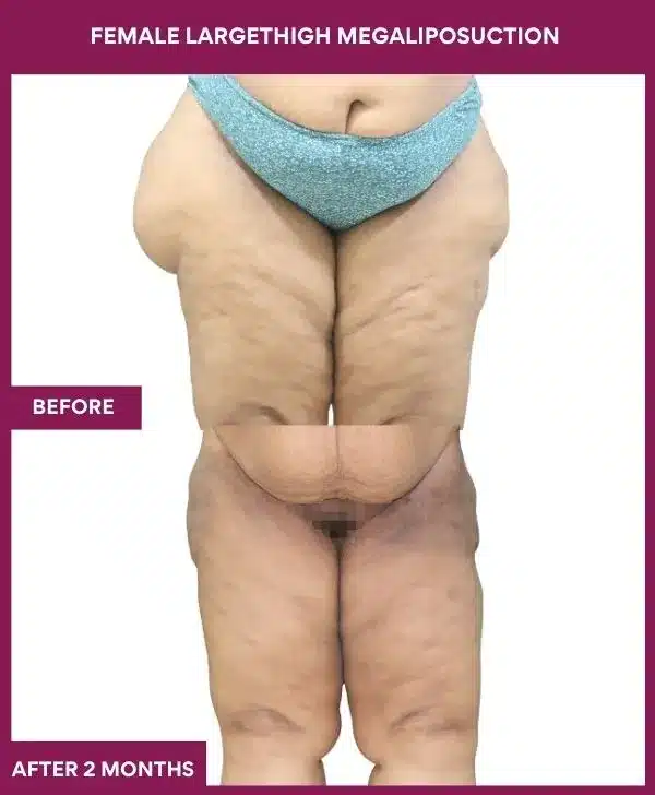 Liposuction Before After Gallery 133 FEMALE LARGE THIGH MEGA LIPOSUCTION in Mumbai, India