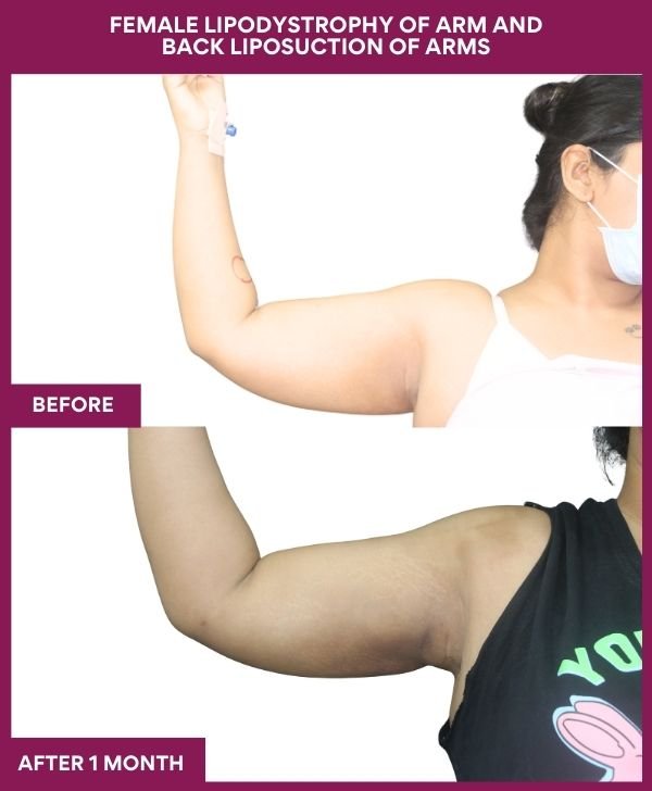 Liposuction Before After Gallery 117 FEMALE LIPODYSTROPHY OF ARM AND BACK LIPOSUCTION OF ARMS in Mumbai, India