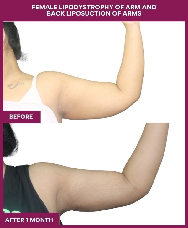 Liposuction Before After Gallery 116 FEMALE LIPODYSTROPHY OF ARM AND BACK LIPOSUCTION OF ARMS in Mumbai, India