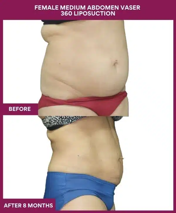 Liposuction Before After Gallery 4 FEMALE MEDIUM ABDOMEN VASER 360 LIPOSUCTION in Mumbai, India
