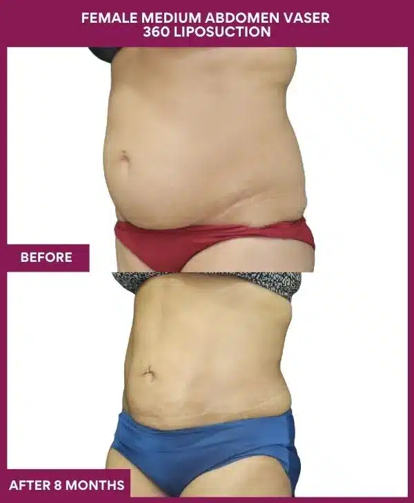 Liposuction Before After Gallery 2 FEMALE MEDIUM ABDOMEN VASER 360 LIPOSUCTION in Mumbai, India