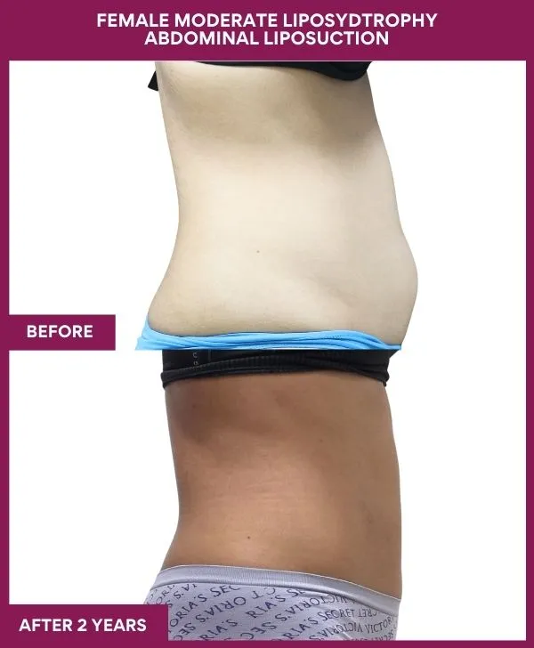 Liposuction Before After Gallery 10 FEMALE MODERATE LIPOSYDTROPHY ABDOMINAL LIPOSUCTION in Mumbai, India