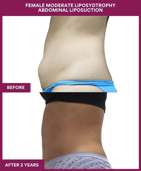 Liposuction Before After Gallery 8 FEMALE MODERATE LIPOSYDTROPHY ABDOMINAL LIPOSUCTION in Mumbai, India