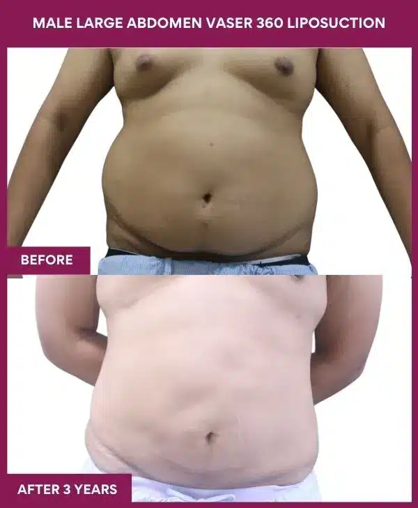 Liposuction Before After Gallery 54 MALE LARGE ABDOMEN VASER 360 LIPOSUCTION in Mumbai, India