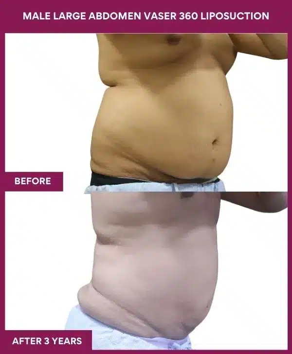 Liposuction Before After Gallery 55 MALE LARGE ABDOMEN VASER 360 LIPOSUCTION in Mumbai, India