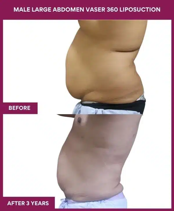 Liposuction Before After Gallery 53 MALE LARGE ABDOMEN VASER 360 LIPOSUCTION in Mumbai, India