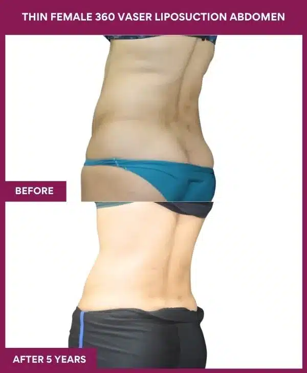 Liposuction Before After Gallery 5 THIN FEMALE 360 VASER LIPOSUCTION ABDOMEN (2)_96_