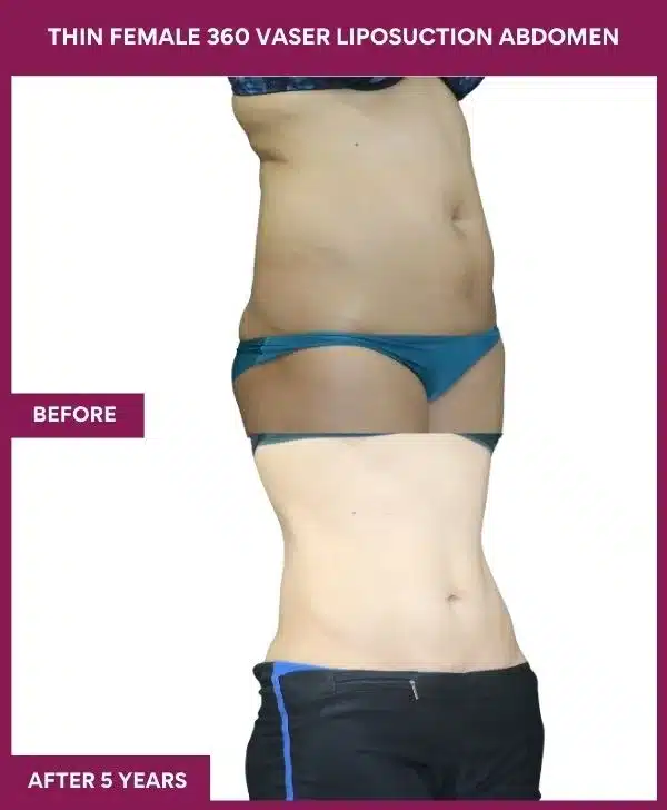 Liposuction Before After Gallery 7 THIN FEMALE 360 VASER LIPOSUCTION ABDOMEN (3)_96_