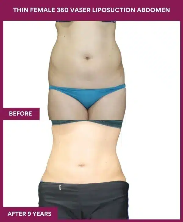 Liposuction Before After Gallery 6 THIN FEMALE 360 VASER LIPOSUCTION ABDOMEN (4)_96_